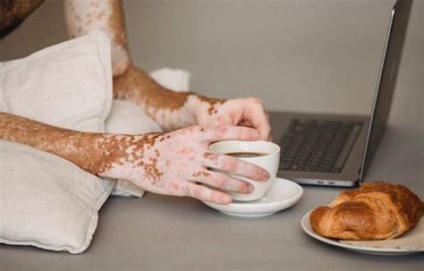 gaufre bleu maladie photo|La maladie de la gaufre bleue : les causes, les。